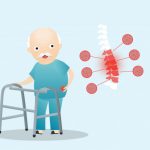 Osteoporose: uma doença que chega com o avanço da idade